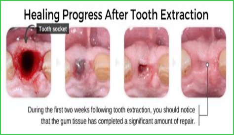 How long does it take for a molar extraction to heal?
